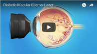 Diabetic Macular Edema: Laser