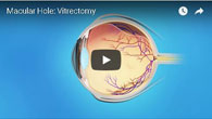 Macular Hole: Vitrectomy